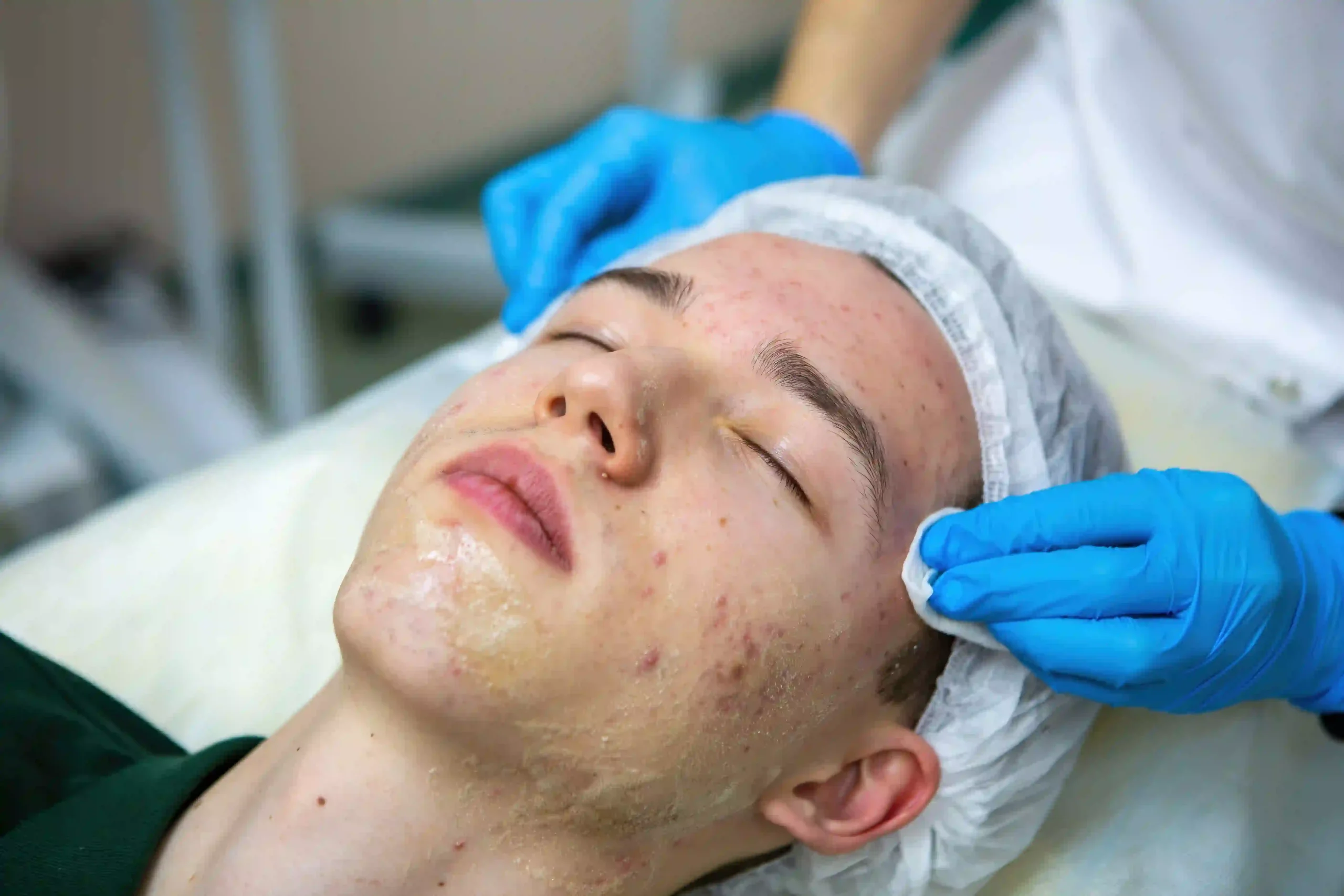 Effective Acne Scar Reduction at TrueCare Medical