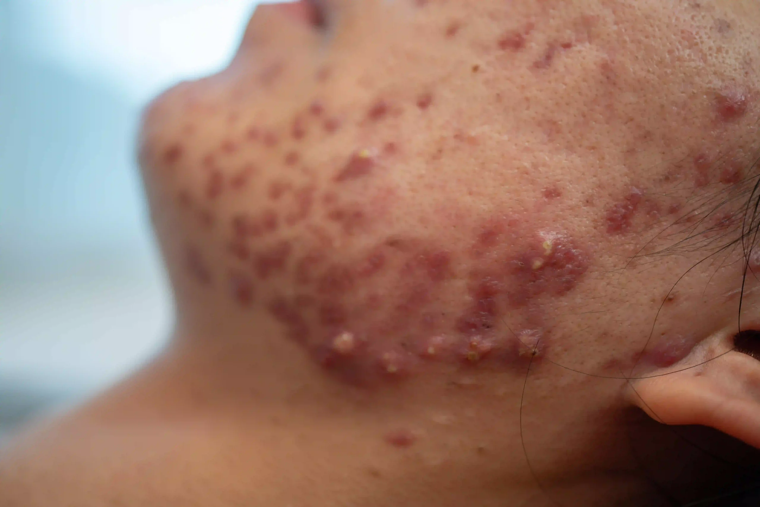 Acne Scars