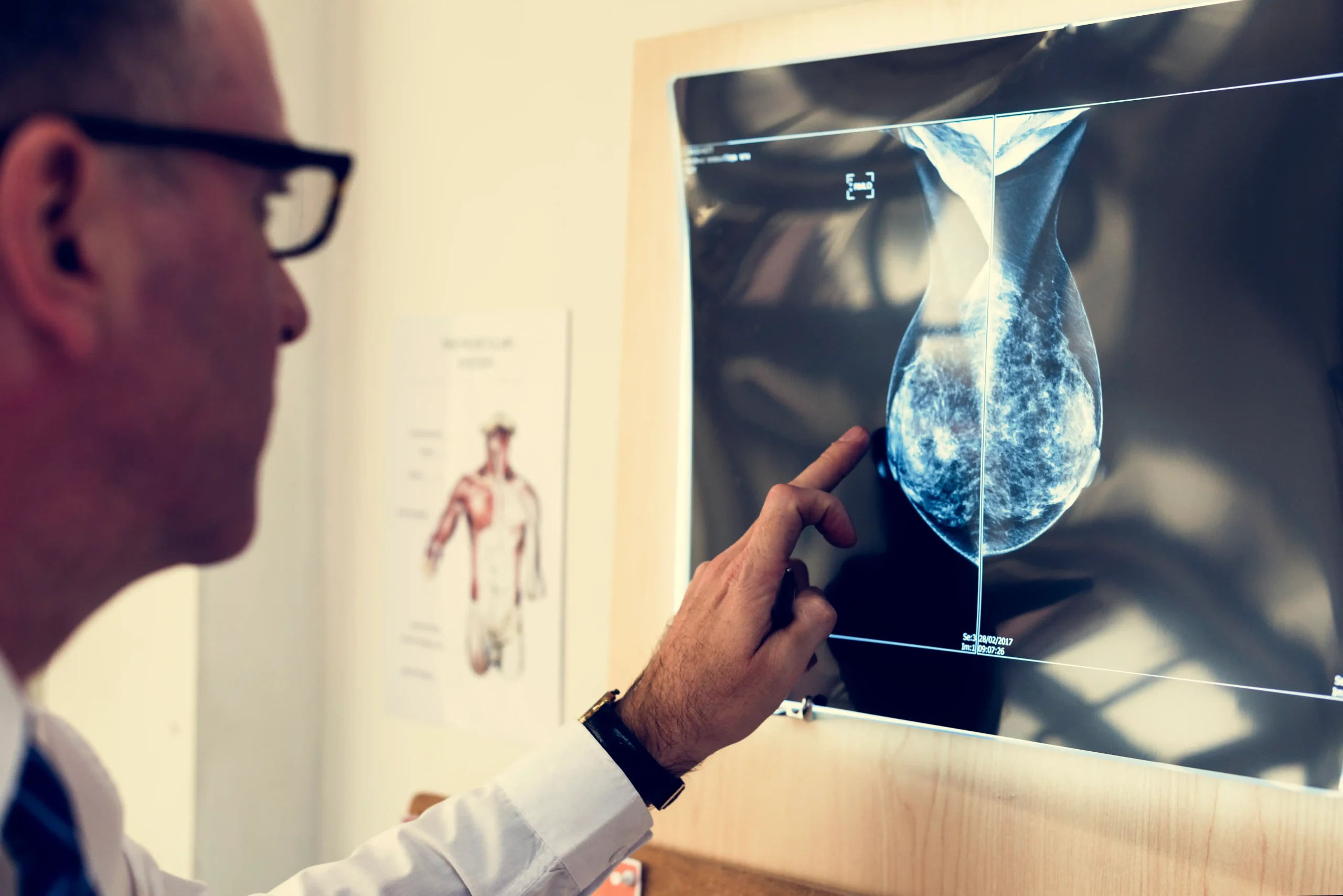 Mobile Mammogram
